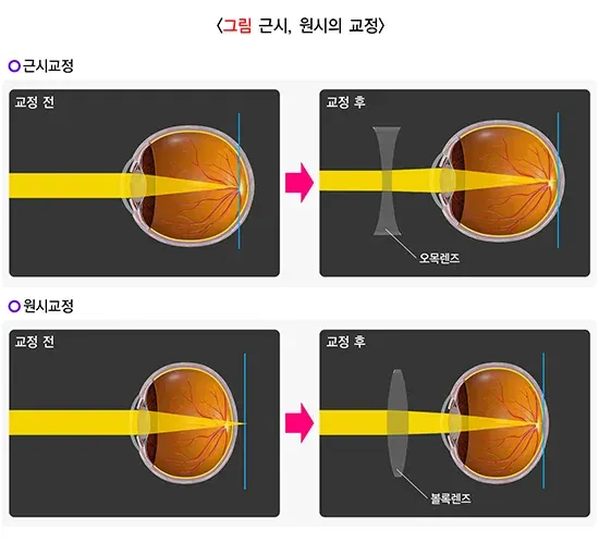 굴절이상(근시, 원시, 난시) 치료 설명 이미지 1