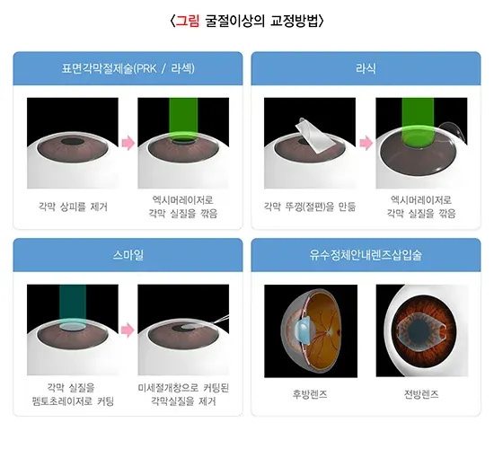 근시교정수술 치료 방법 설명 이미지 1