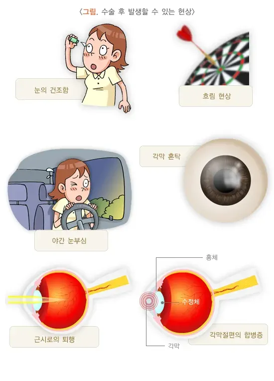 근시교정수술 치료 관련 합병증 및 부작용 설명 이미지 1