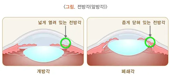 녹내장 종류 설명 이미지 1