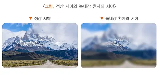 녹내장 증상 설명 이미지 1