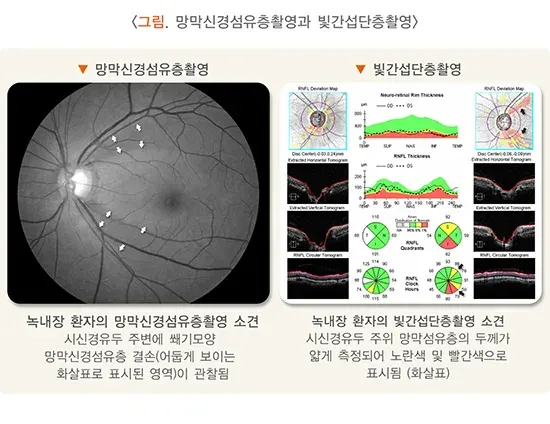 녹내장 진단 및 검사 설명 이미지 2