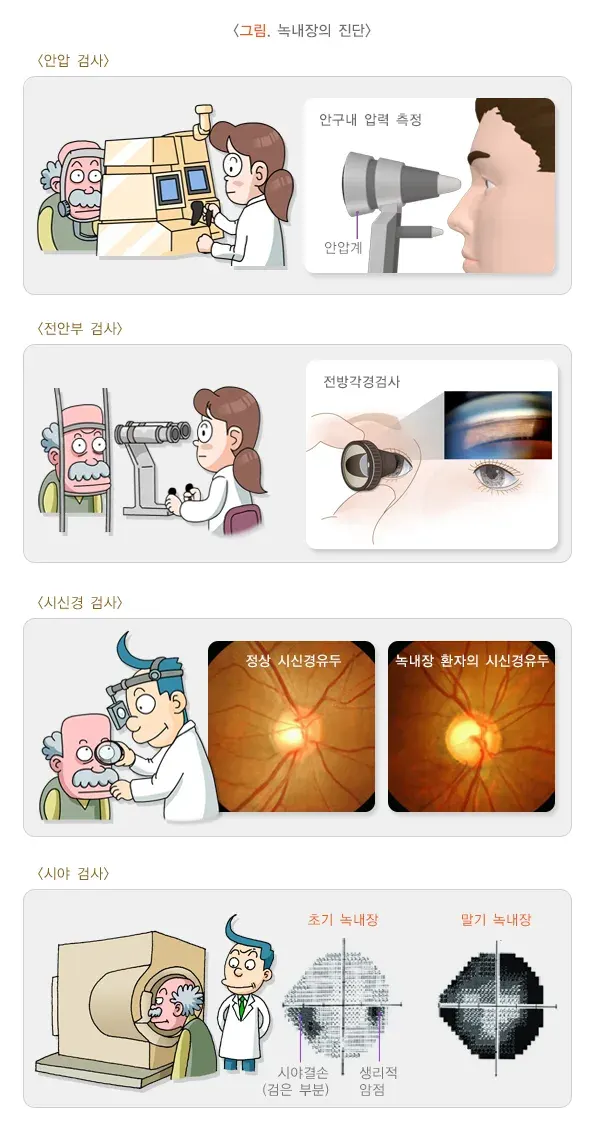 녹내장 진단 및 검사 설명 이미지 1