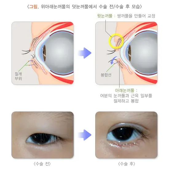 덧눈꺼풀 치료 설명 이미지 1