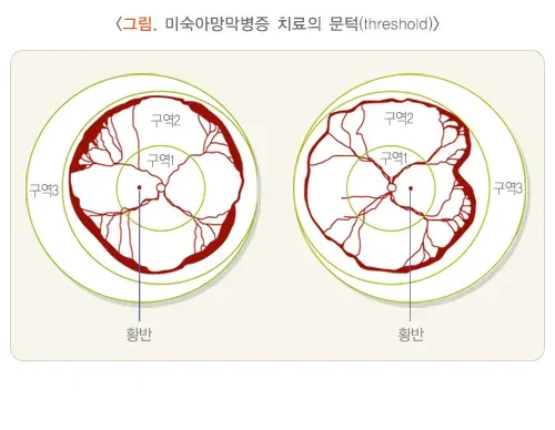 미숙아망막병증 치료 설명 이미지 1
