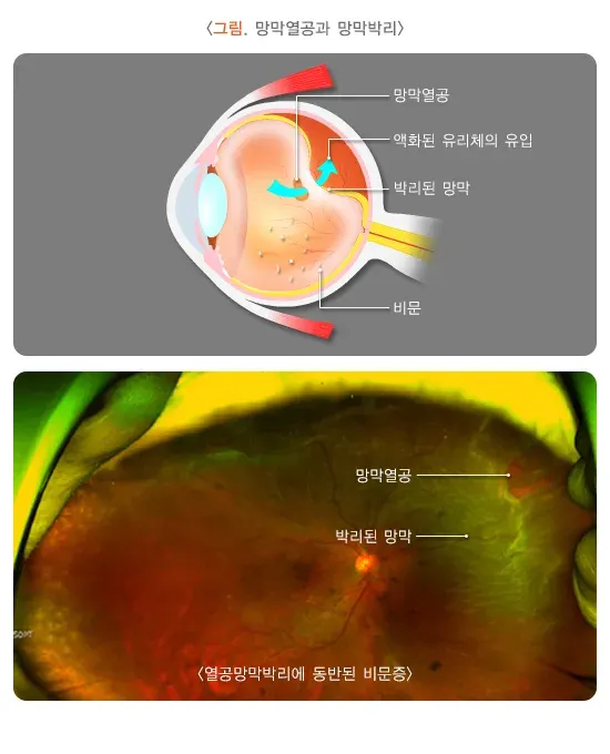 비문증 병태생리 설명 이미지 2