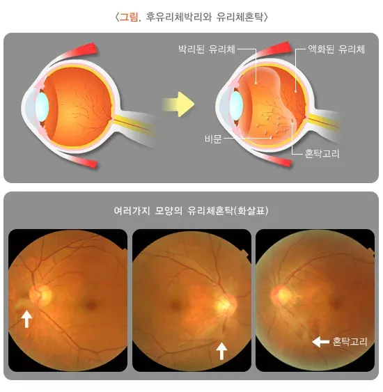 비문증 병태생리 설명 이미지 1