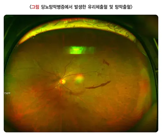비문증 병태생리 설명 이미지 3