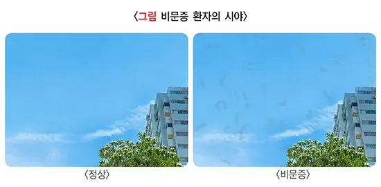 비문증 증상 설명 이미지 1