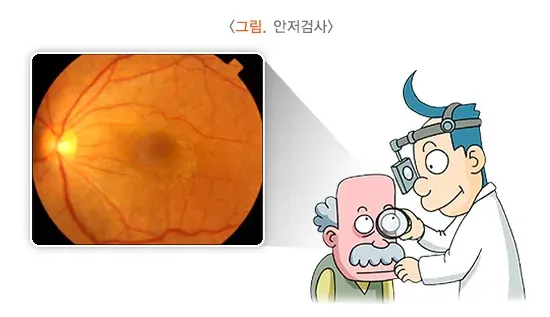 비문증 진단 및 검사 설명 이미지 1