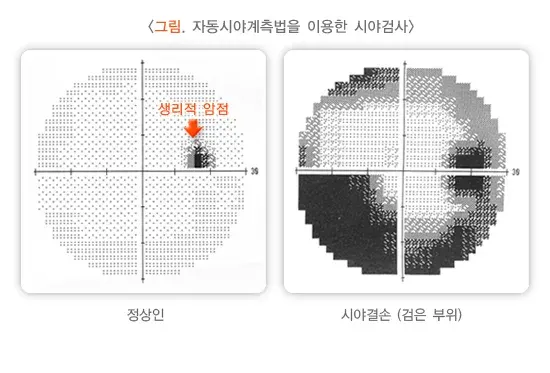 저시력 진단 및 검사 설명 이미지 2