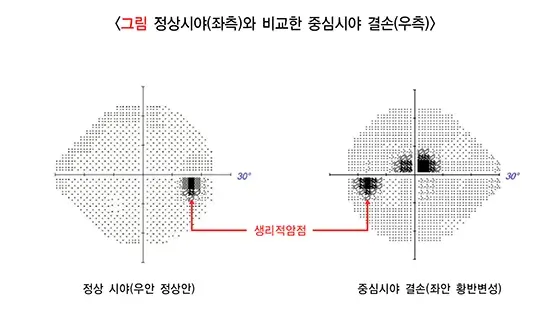 저시력 연관 증상 설명 이미지 2