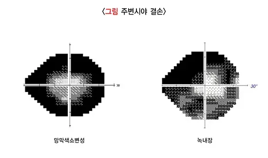 저시력 연관 증상 설명 이미지 3