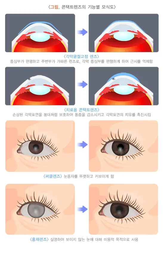 콘택트렌즈 치료 방법 설명 이미지 1