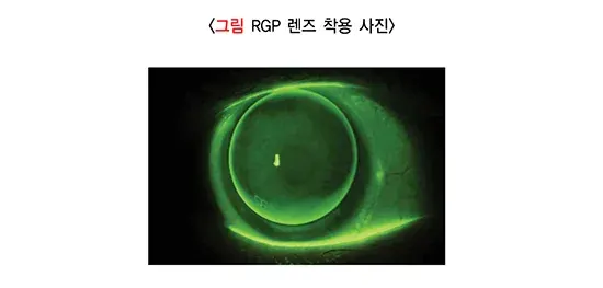 콘택트렌즈 치료 방법 설명 이미지 3