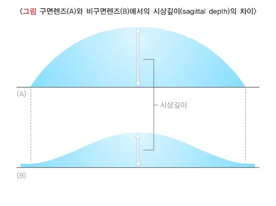 콘택트렌즈 치료 방법 설명 이미지 2