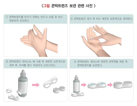 콘택트렌즈 치료 관련 주의사항 설명 이미지 2