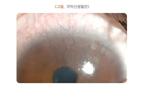 콘택트렌즈 치료 관련 합병증 및 부작용 설명 이미지 2