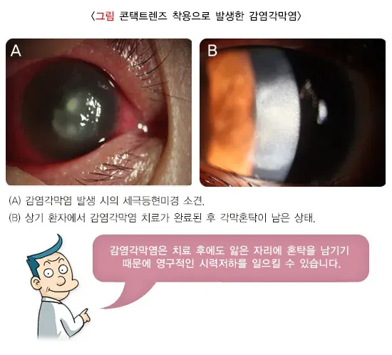 콘택트렌즈 치료 관련 합병증 및 부작용 설명 이미지 3