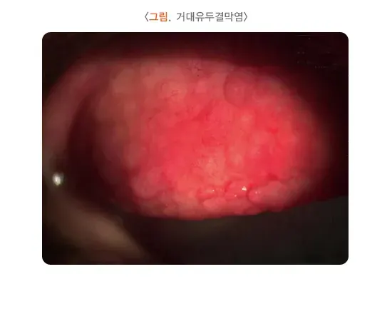 콘택트렌즈 치료 관련 합병증 및 부작용 설명 이미지 1
