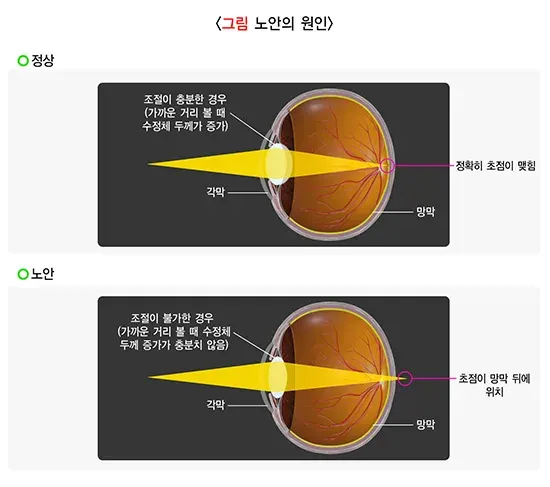 노안 원인 설명 이미지 1