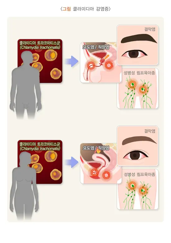 성매개감염병 증상 설명 이미지 3