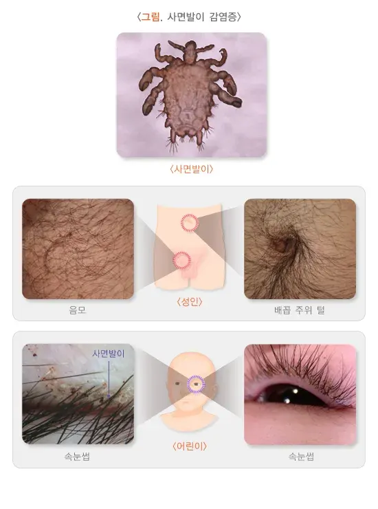 성매개감염병 증상 설명 이미지 4