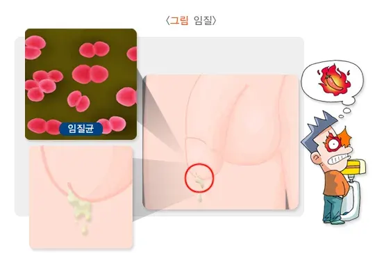 성매개감염병 증상 설명 이미지 2