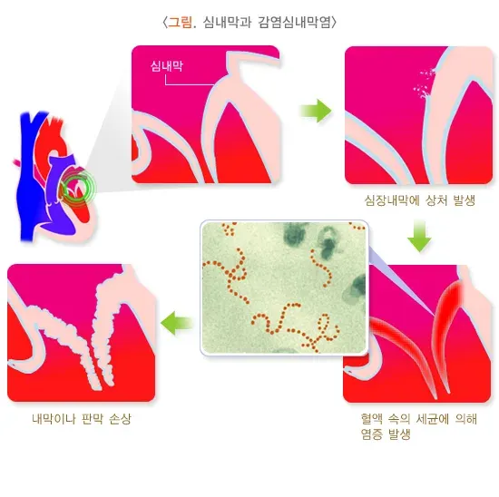 감염심내막염 정의 설명 이미지 1