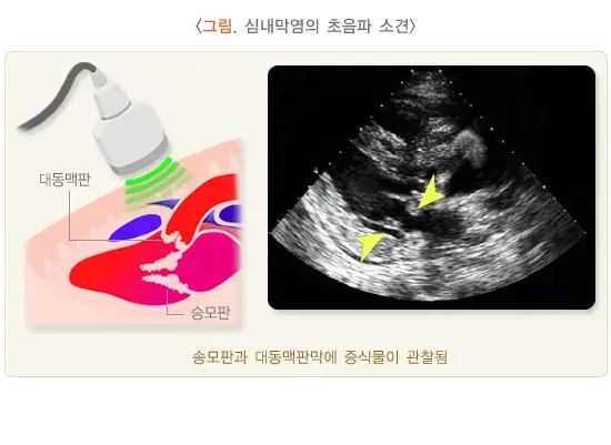 감염심내막염 진단 및 검사 설명 이미지 1