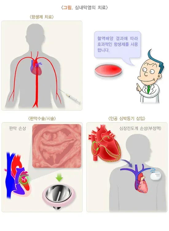 감염심내막염 치료 설명 이미지 1
