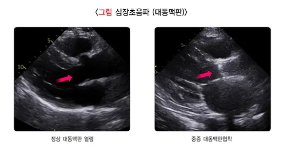 심장 판막 질환 진단 및 검사 설명 이미지 3