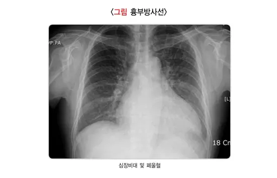 심장 판막 질환 진단 및 검사 설명 이미지 1