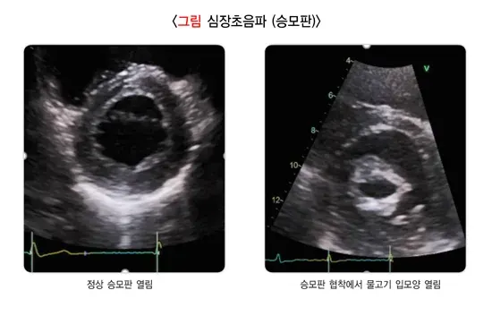 심장 판막 질환 진단 및 검사 설명 이미지 2