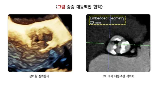 심장 판막 질환 진단 및 검사 설명 이미지 4