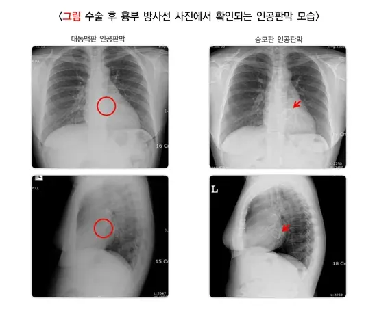 심장 판막 질환 치료 설명 이미지 4