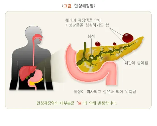 췌장염 정의 설명 이미지 2