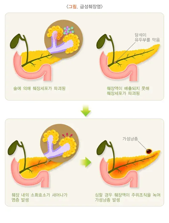 췌장염 정의 설명 이미지 1
