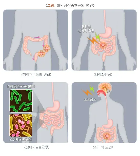 과민성장증후군 원인 설명 이미지 1