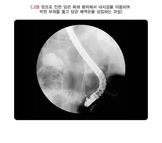 내시경적 역행성 담췌관조영술 검사 목적 설명 이미지 2