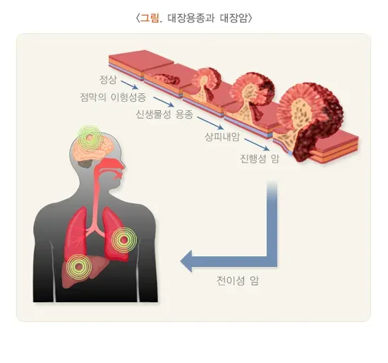 대장용종 병태생리 설명 이미지 1