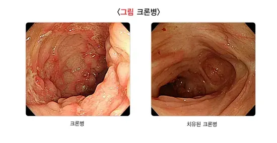 대장내시경검사 검사 결과 해석 설명 이미지 7