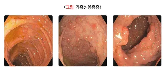 대장내시경검사 검사 결과 해석 설명 이미지 3
