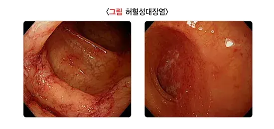 대장내시경검사 검사 결과 해석 설명 이미지 8