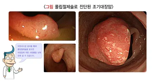 대장내시경검사 검사 결과 해석 설명 이미지 4