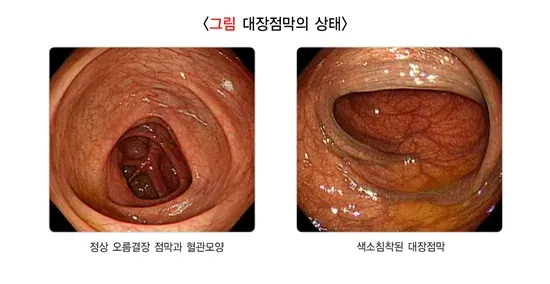 대장내시경검사 검사 결과 해석 설명 이미지 2