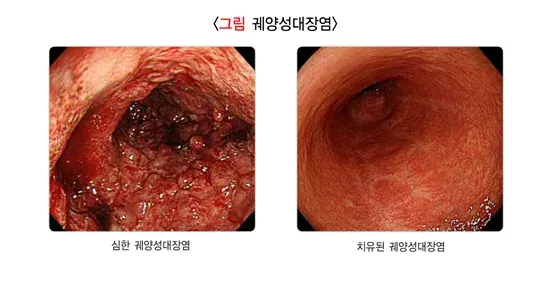 대장내시경검사 검사 결과 해석 설명 이미지 6