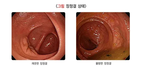 대장내시경검사 검사 결과 해석 설명 이미지 1