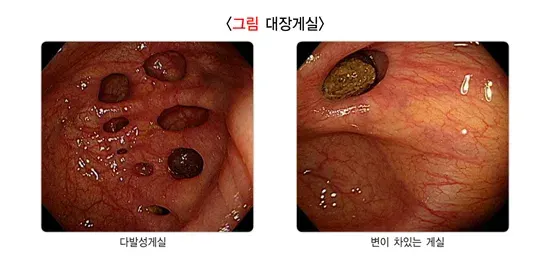 대장내시경검사 검사 결과 해석 설명 이미지 5
