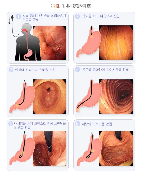 위내시경 검사 절차 설명 이미지 1
